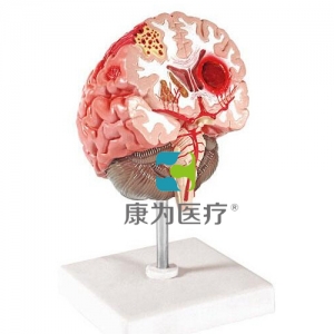 “康為醫療”腦中風模型