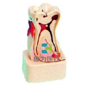 “康為醫療”牙體病綜合病理模型(4倍大)