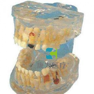 “康為醫療”透明乳牙病理模型