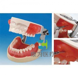“康為醫療”國家醫師考試專用牙槽膿腫切開與牙體預備模型